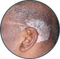 Scalp Patient 2 Before