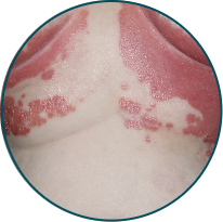 Skin Patient 2 Before