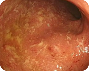 Image from an endoscopic procedure before TREMFYA® (guselkumab) for ulcerative colitis (UC)