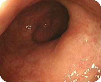 Image from an endoscopic procedure after 1 year on TREMFYA® (guselkumab) for ulcerative colitis (UC)