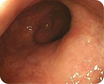 Image from an endoscopic procedure after 1 year on TREMFYA® (guselkumab) for ulcerative colitis (UC)